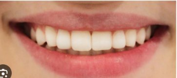 Teeth Whitening after