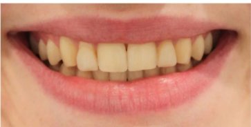 Teeth Whitening before